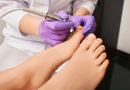infections fongiques des pieds