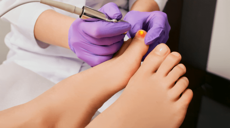 infections fongiques des pieds