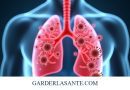 Comprendre la Pneumonie Virale : Causes et Mécanismes